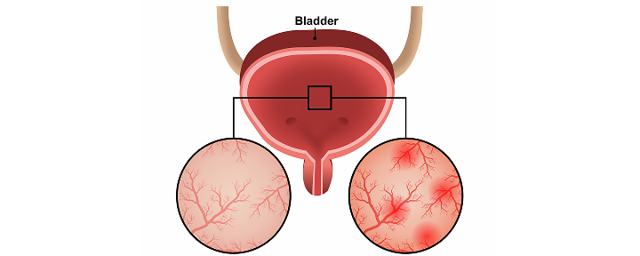 Что такое цистит?
